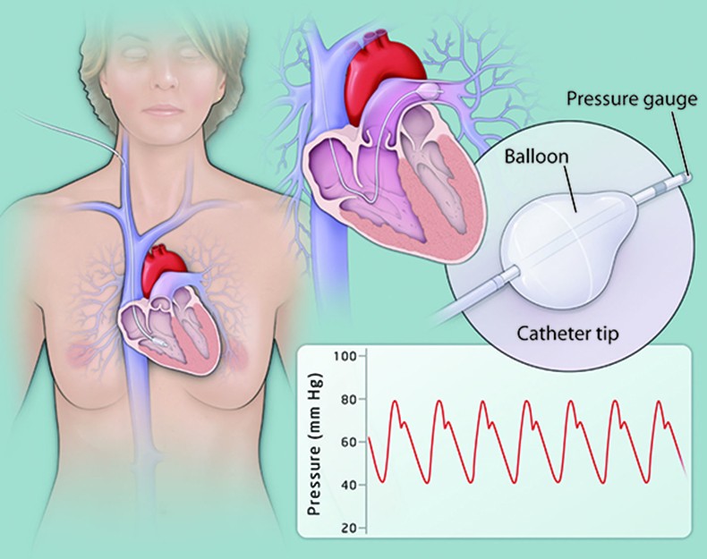 CTEPH Diagnosis