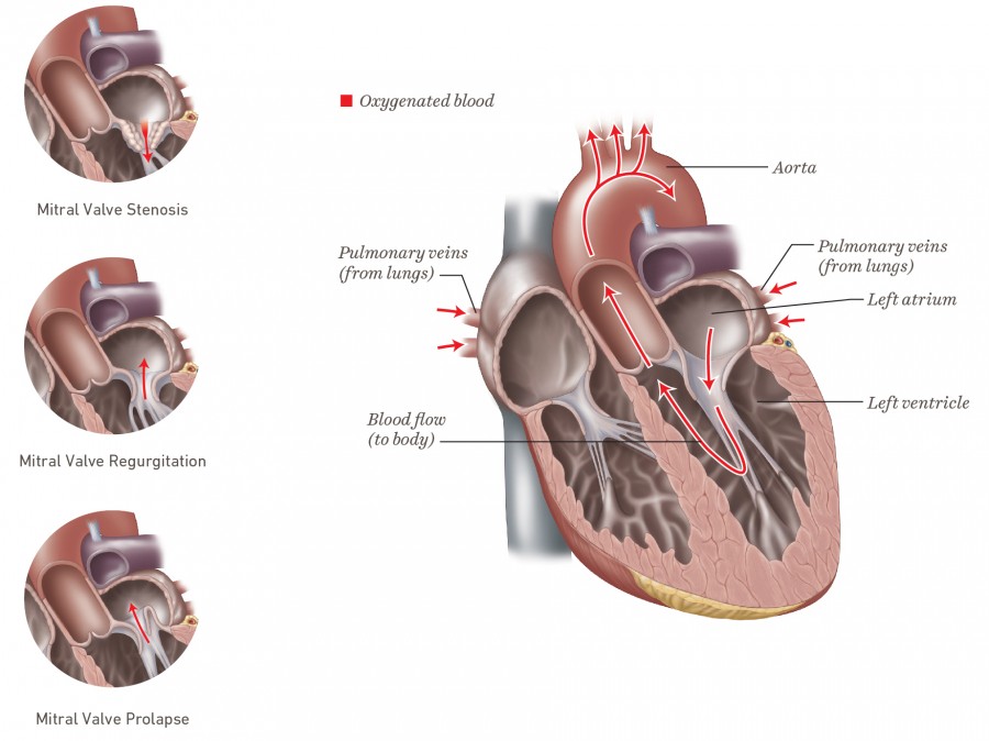 Mitral Valve Disease