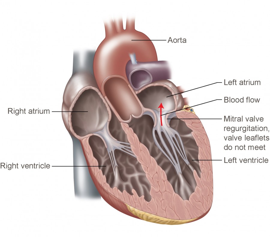 Mitral Valve Regurgitation