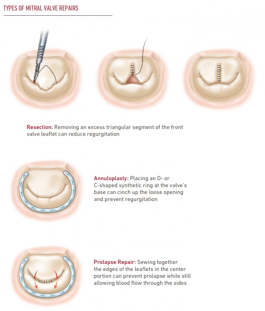 Mitral Valve Repair & Replacement