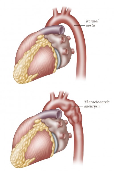 Thoracic Aorta Heart