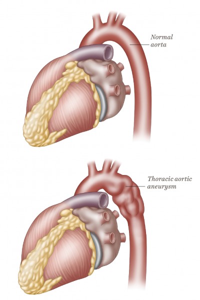 Aortic Aneurysm