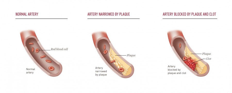 Atherosclerosis