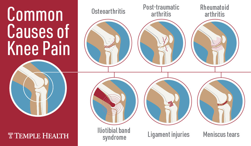 Common causes of knee pain