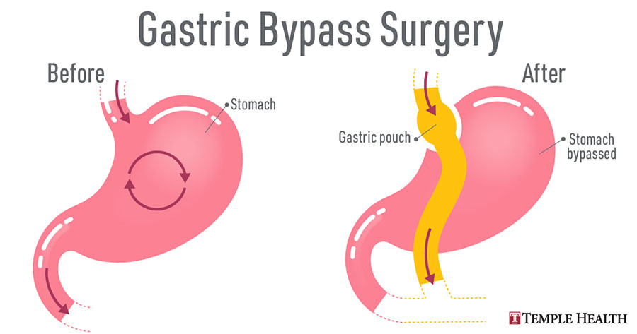 Gastric bypass surgery before and after
