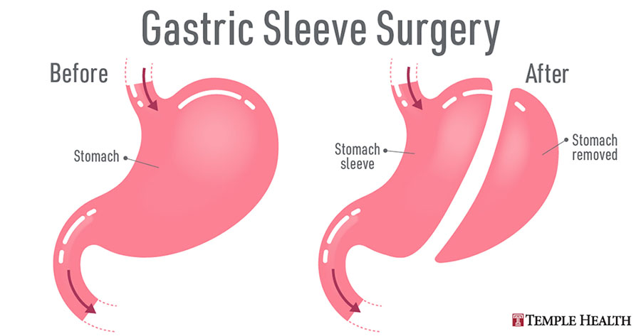 gastric sleeve surgery before and after graphic
