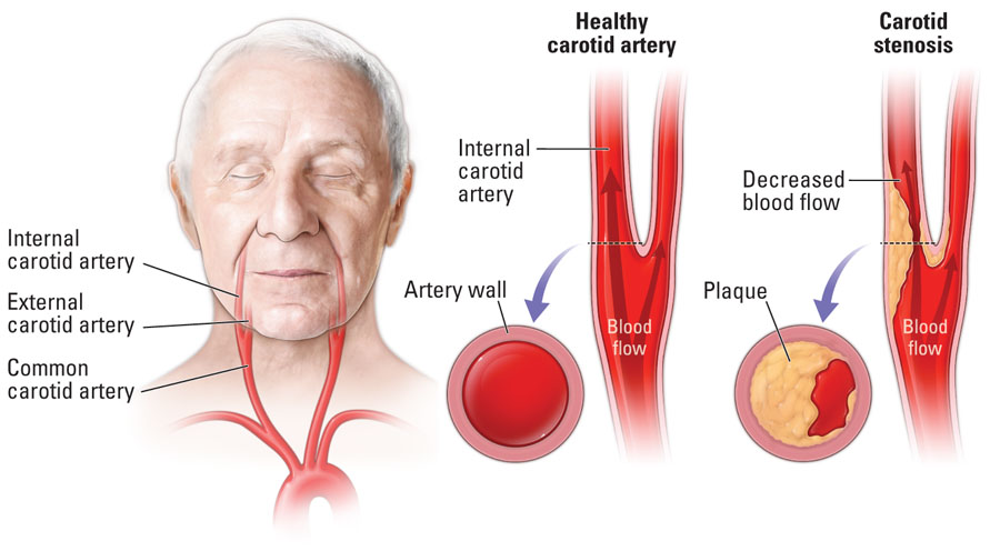 Healthy carotid artery vs carotid stenosis