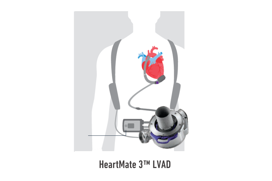 HeartMate LVAD