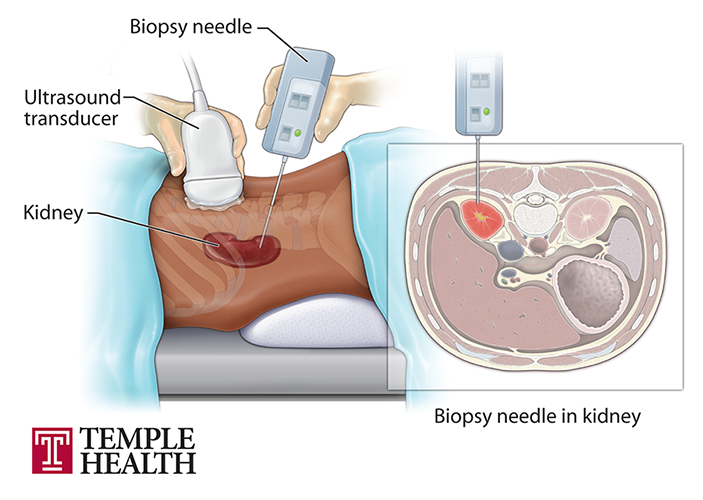 Kidney Biopsy Process