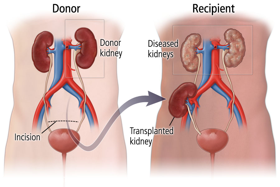 Living kidney donor and recipient illustration
