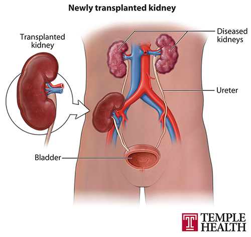 Newly transplanted kidney