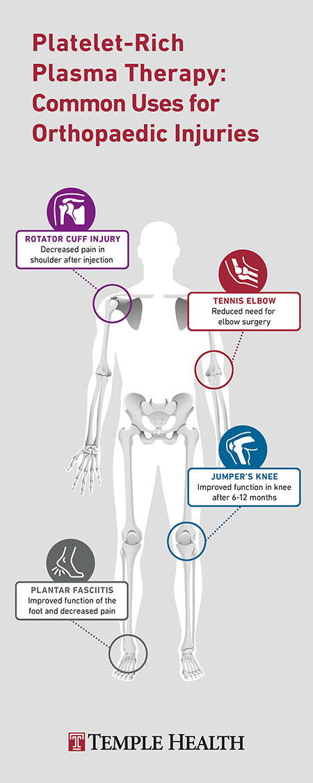 Platelet rich plasma therapy for orthapaedic injuries