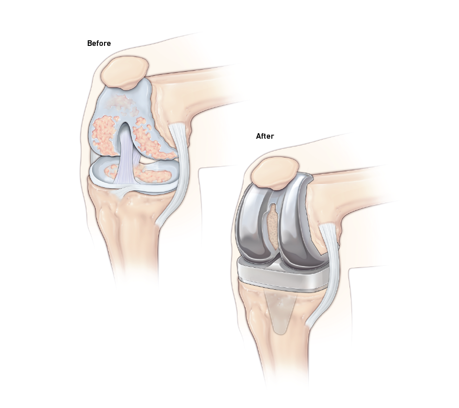 Time for a total knee replacement? - Mayo Clinic Health System