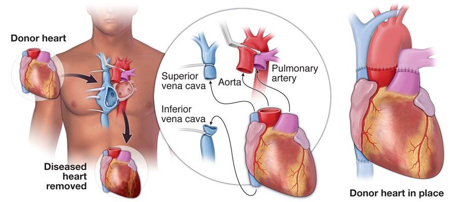 Heart Transplant | Temple Health