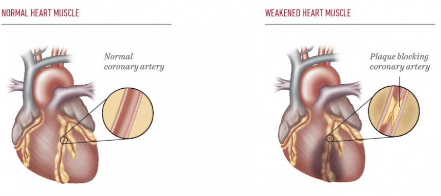 Diagram of normal heart muscle versus weakened heart muscle with plaque blocking the artery