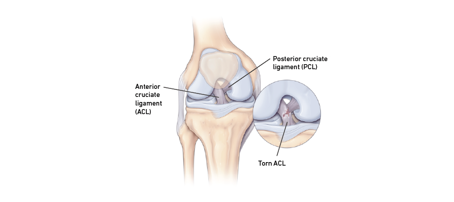 sprained acl sprained acl