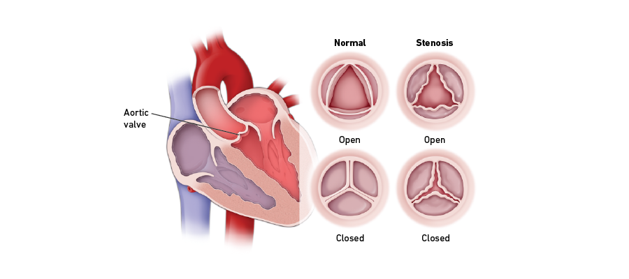 Aortic valve stenosis graphic