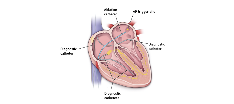 AV node ablation AV node ablation