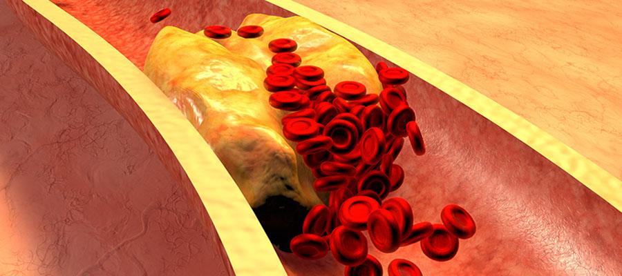 Graphic of blood clot in vein