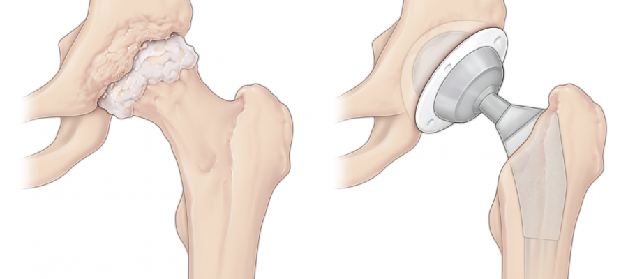 Hip Replacement Surgery >> Hip Replacement Surgery Temple Health Hip Replacement Surgery >> Hip Replacement Surgery Temple Health