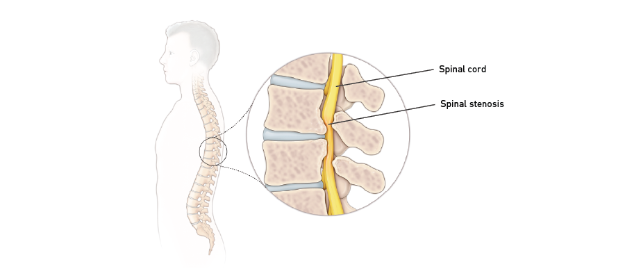 images Stenosis Of The Lower Spine spinal stenosis temple health