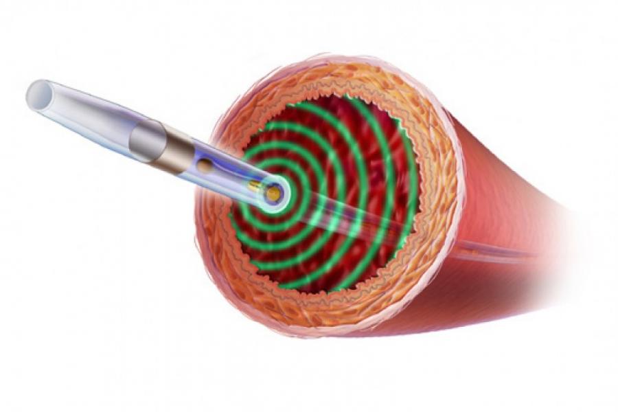 Graphic of EKOS EndoWave Infusion Catheter System