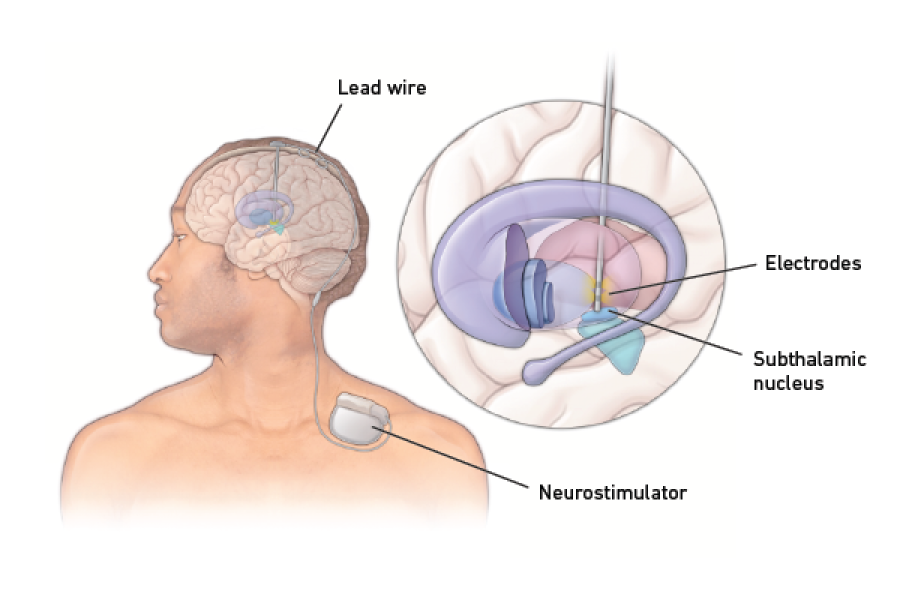 Deep brain stimulation graphic