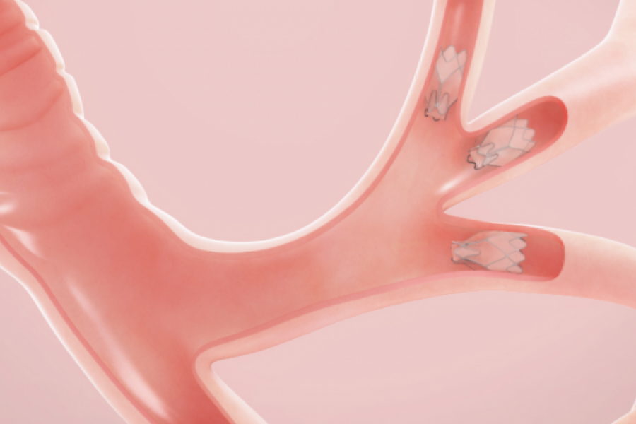 Bronchoscopic Lung Volume Reduction Procedure Temple Health