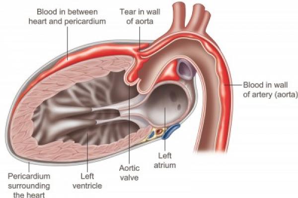 aortic root anatomy