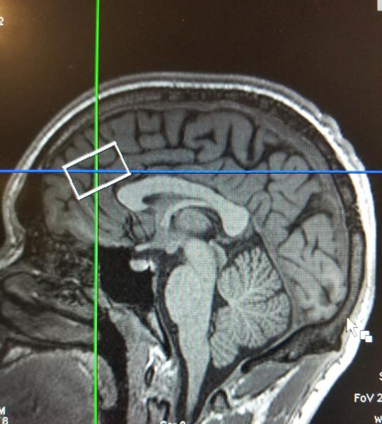 human skull showing anterior cingulate cortex 