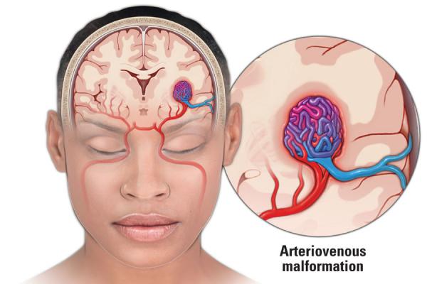 Arteriovenous Malformation (AVM) | Temple Health