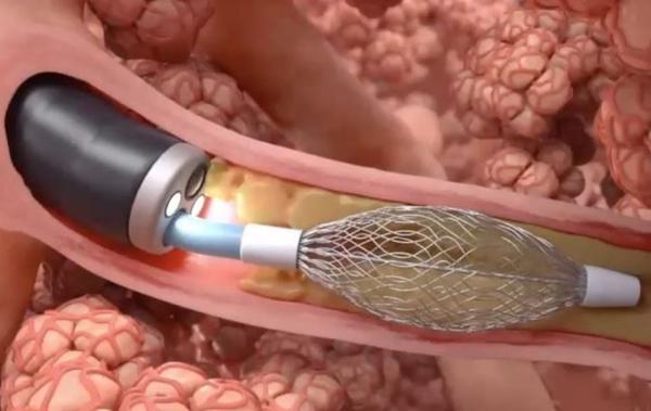 Featured clinical trials: novel bronchoscopic therapies for chronic