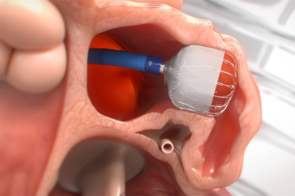 WATCHMAN Device | Temple Health