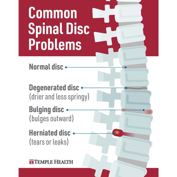 Common spinal disc problems: normal disc, degenerated disc, bulging disc and herniated disc