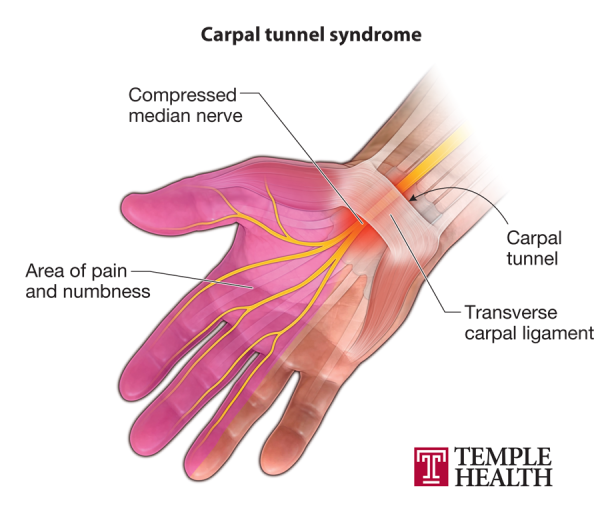 Is your wrist pain carpal tunnel syndrome?