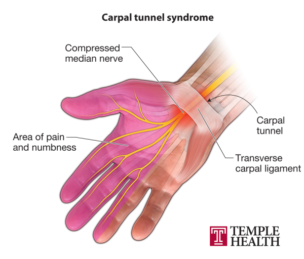 https://www.templehealth.org/sites/default/files/styles/without_crop/public/2022-06/carpal_final.png?itok=UvhICQJO