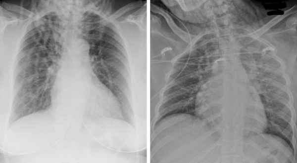 (Left) How a hairstyle of thick cornrows braided down presents on a chest x-ray; (right) how large braids present on a chest x-ray.