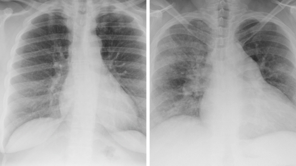(Left) How large twists appear on a chest x-ray; (right) how small braids, starting with cornrows on the scalp, present on a chest x-ray.  