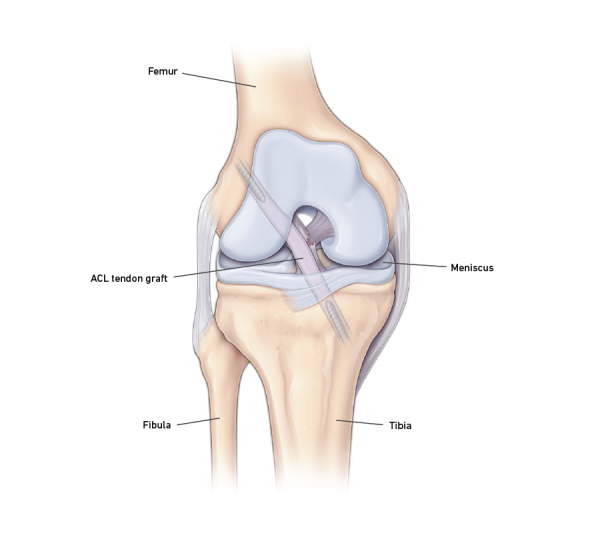 ACL Reconstruction | Temple Health ACL Reconstruction | Temple Health