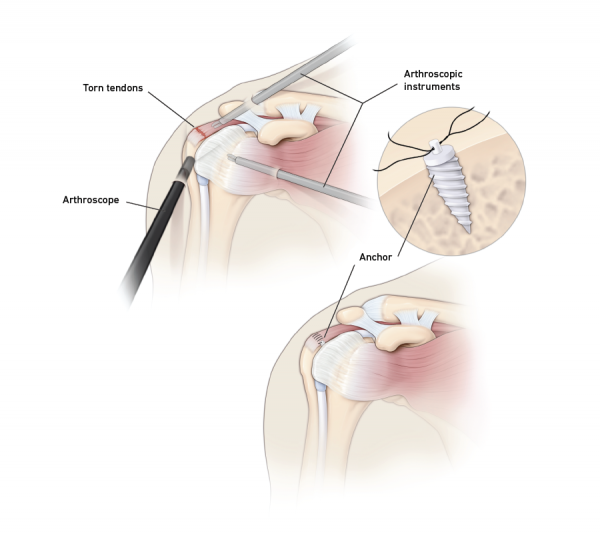 Shoulder Surgery Support Group (Rotator Cuff Tears & arthritis) Public  Group