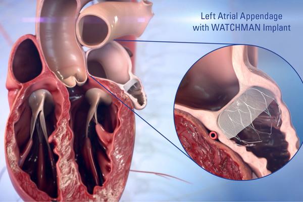 WATCHMAN device being implanted in the heart